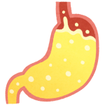 胃酸の逆流のイラスト