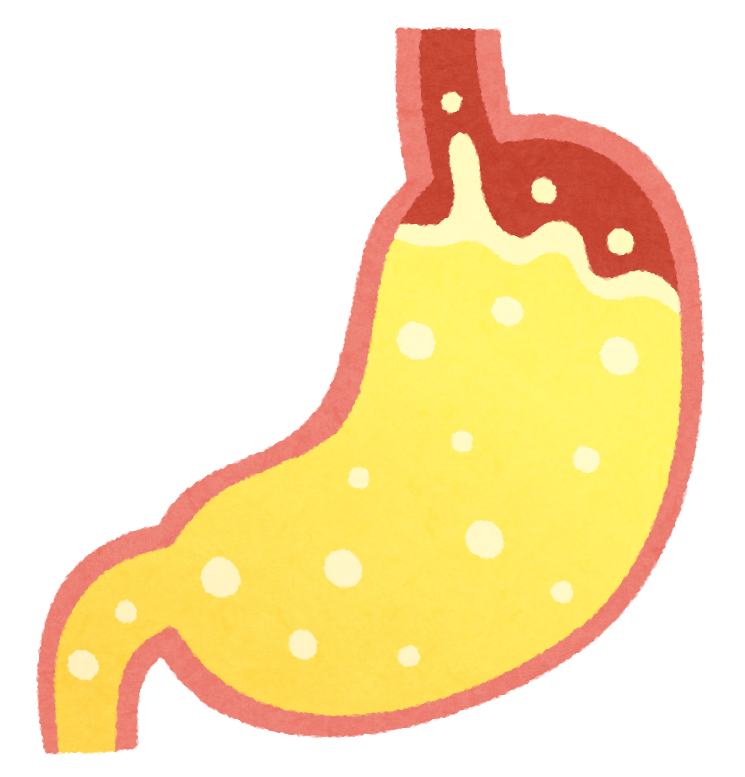 胃酸の逆流のイラスト